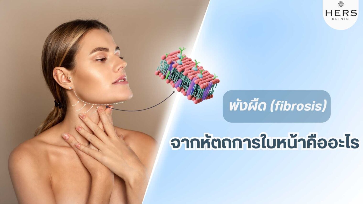 พังผืด (fibrosis) จากหัตถการใบหน้าคืออะไร