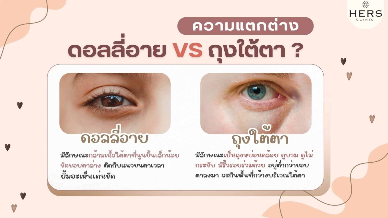 ความแตกต่าง Dolly eye & ถุงใต้ตา