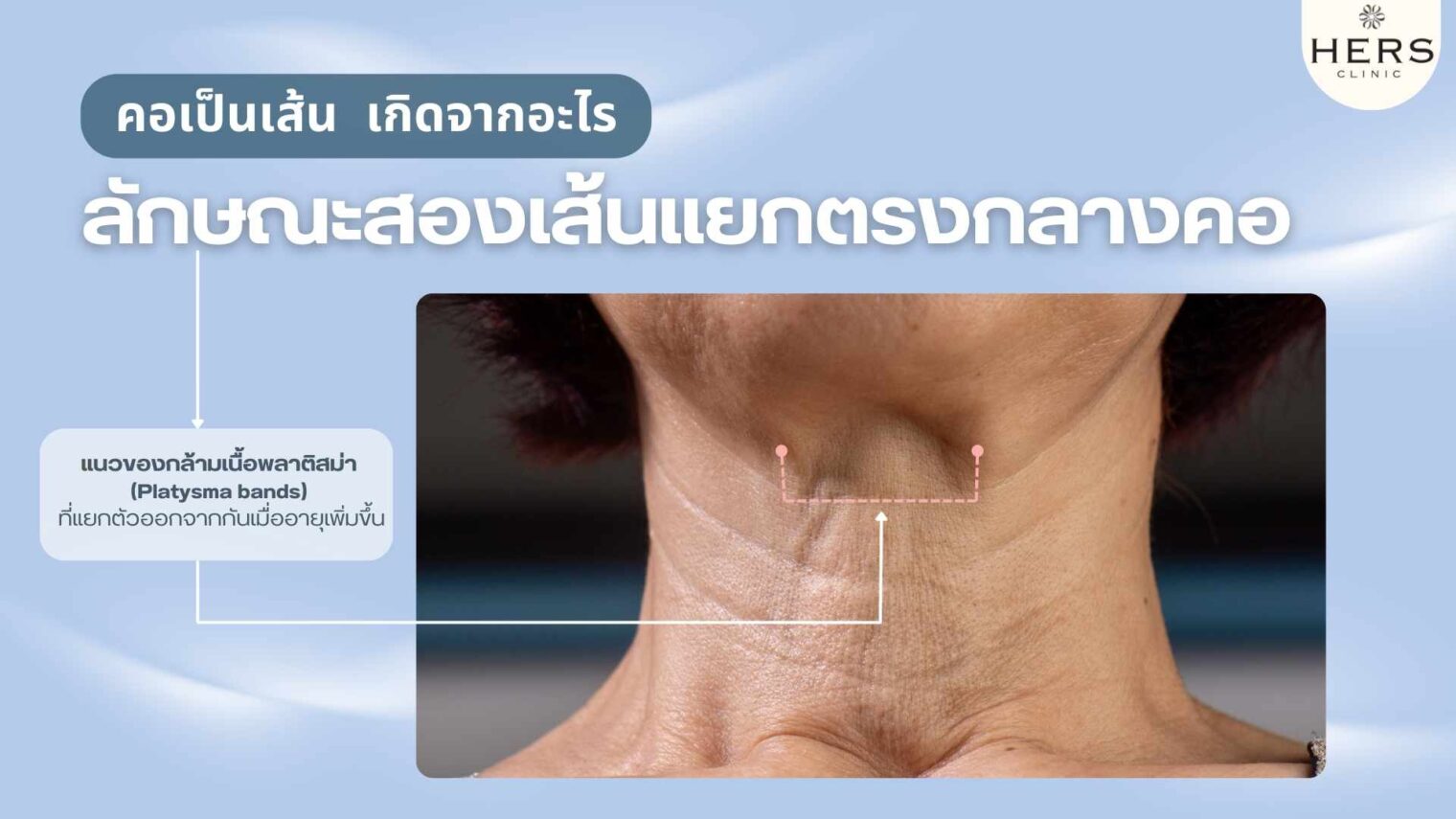 คอเป็นเส้น คอเป็นรอยพับ คอเหี่ยว เกิดจากอะไร - 1