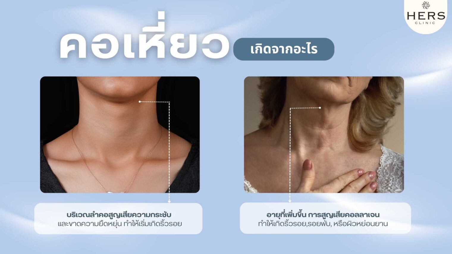 คอเป็นเส้น คอเป็นรอยพับ คอเหี่ยว เกิดจากอะไร - 3