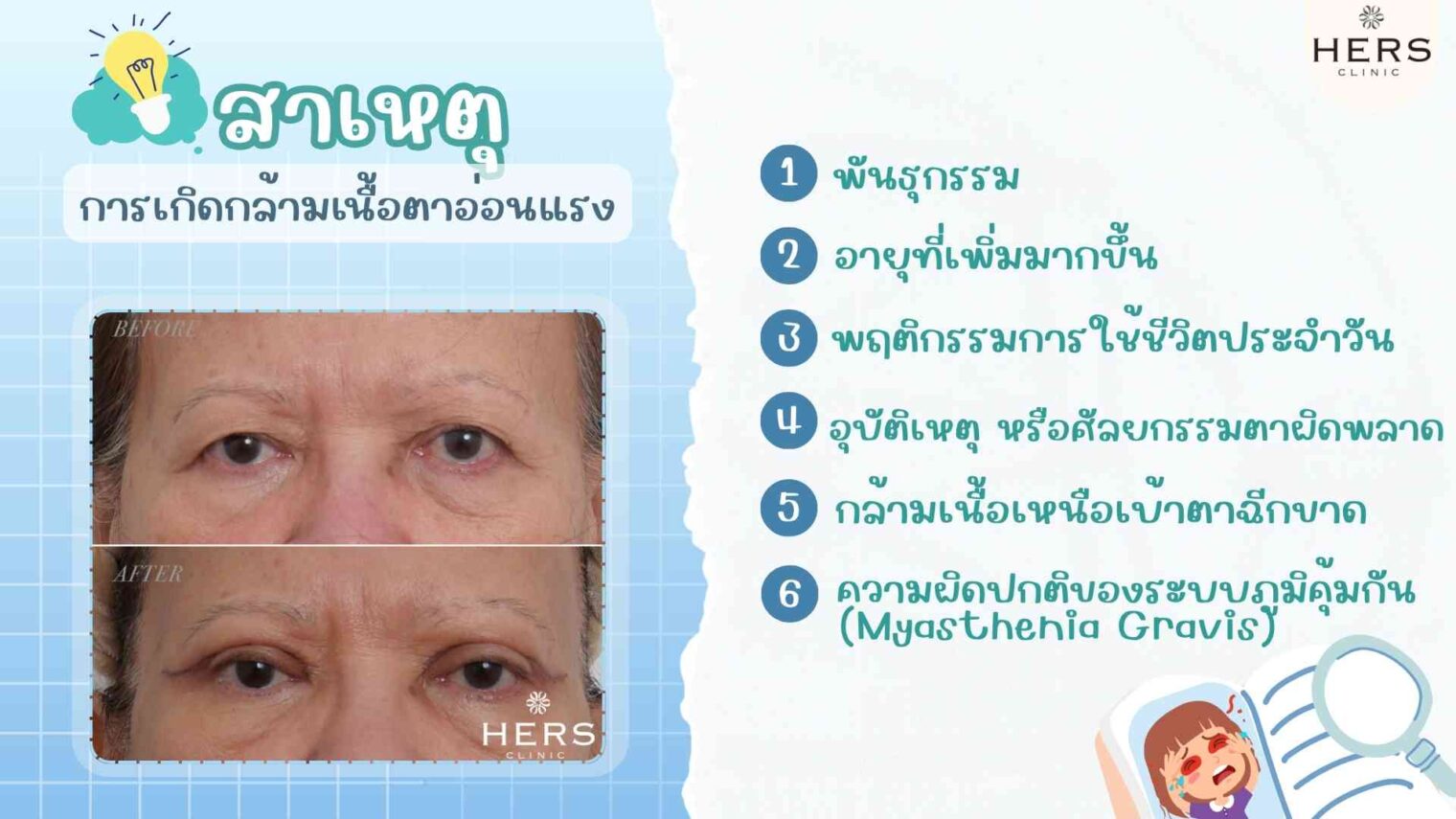 สาเหตุของการเกิดกล้ามเนื้อตาอ่อนแรง