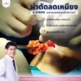 ผ่าตัดเหนียง Corset Neck Lift