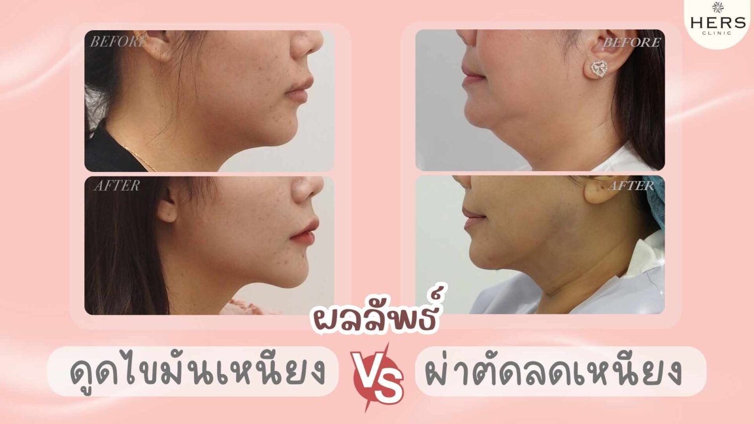 ผลลัพธ์ดูดไขมันเหนียงVSผ่าตัดลดเหนียง