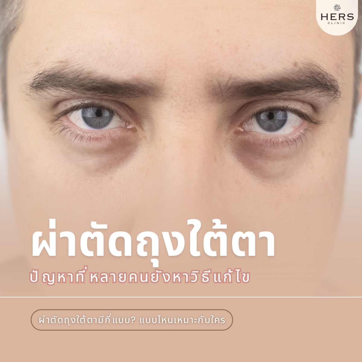 ผ่าตัดถุงใต้ตา ปัญหาที่หลายคนยังหาวิธีแก้ไข