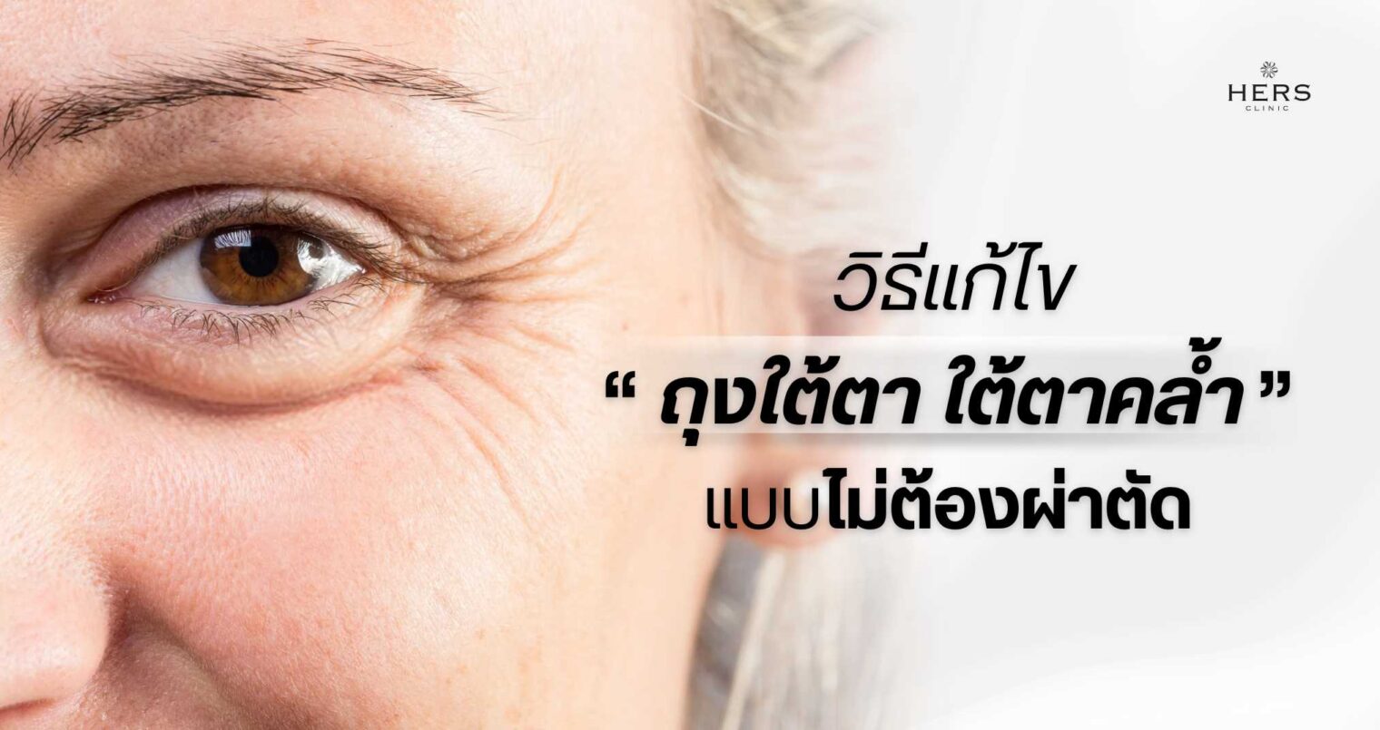 วิธีแก้ ถุงใต้ตา ใต้ตาคล้ำ แบบไม่ต้องผ่าตัด