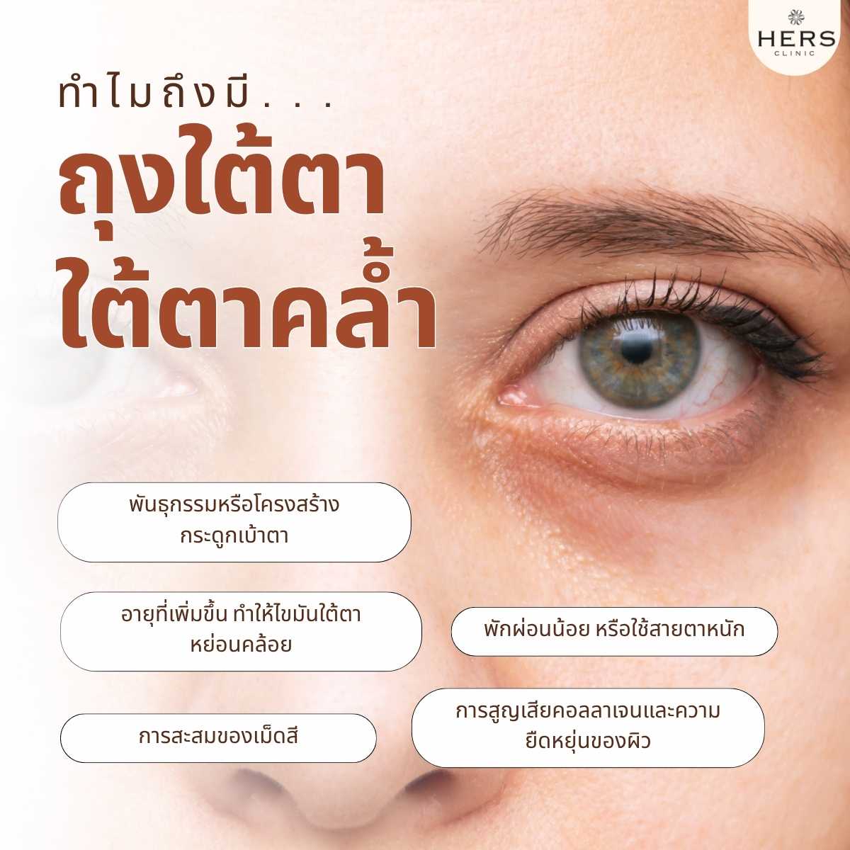 ทำไมถึงมี ถุงใต้ตา ใต้ตาคล้ำ