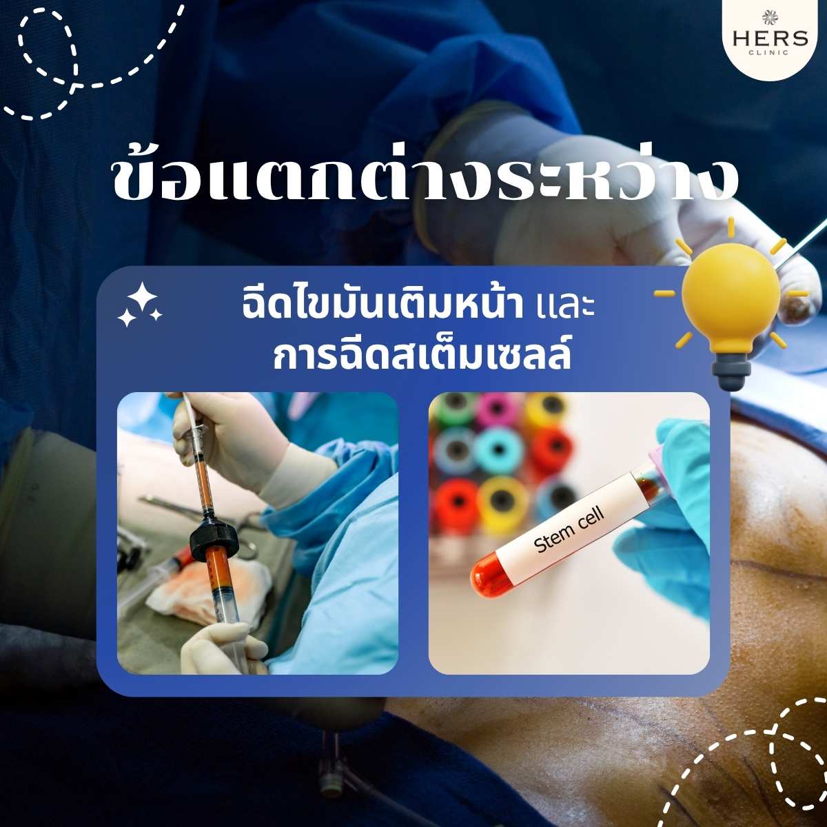ข้อแตกต่างระหว่าง ฉีดไขมันเติมหน้า และ การฉีดสเต็มเซลล์