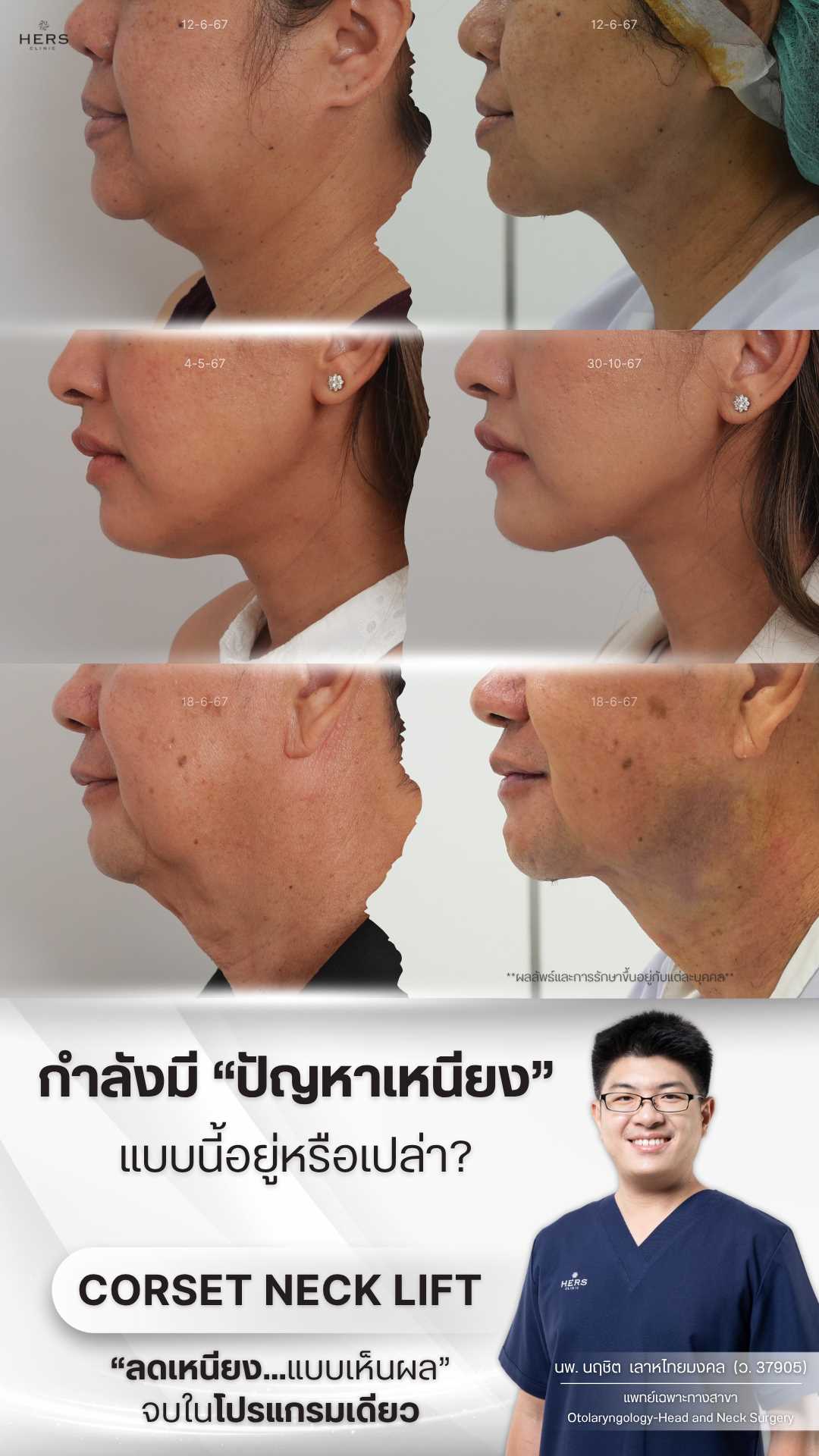 โปรแกรม Corset Neck Lift ที่ HERS Clinic