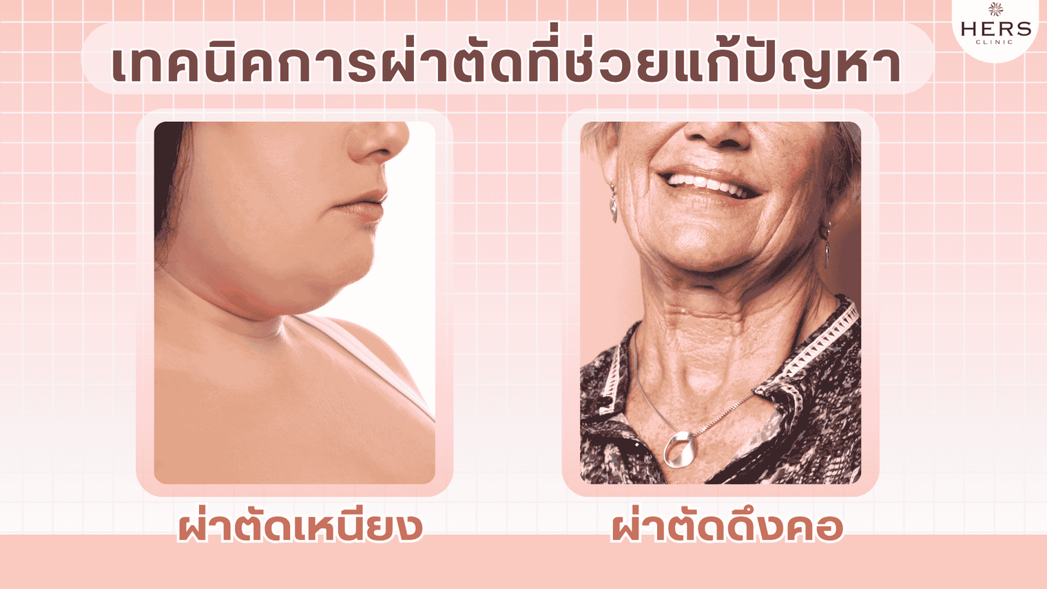 เทคนิคการ ผ่าตัดเหนียง