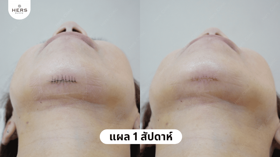 ผ่าตัดเหนียง เปิดแผลบริเวณไหน